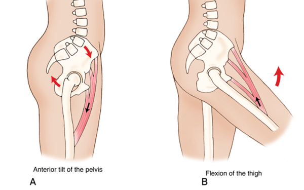 Anterior tilt of the pelvis on the left compared to flexion of the thigh on the right.