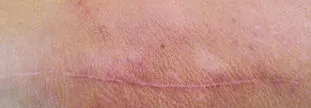 Incision after author's daily self-massage for six months. The scar is almost not noticeable.