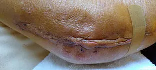 Author's elbow incision after surgery.