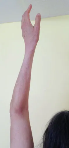 An elbow fracture with fractured radial head after 10 months of intensive rehab.