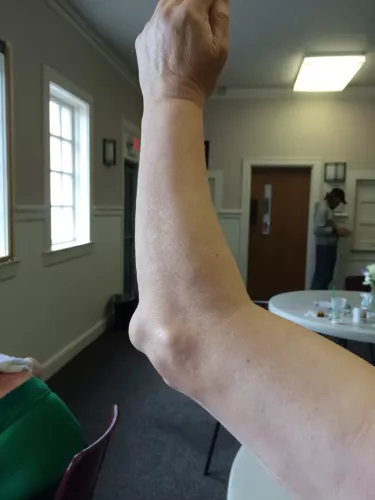 An upper elbow fracture, with no rehabilitation. Patient has limited extension as a result.