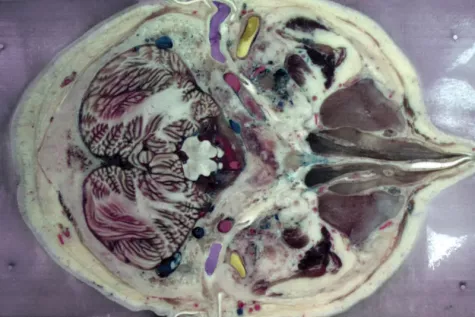 Cross section of the head, at the level of the temporomandibular joints' articular discs (highlighted in yellow) and the ear canal nearby.