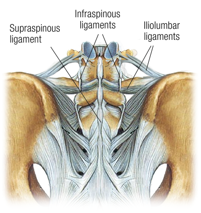 the infraspinous ligaments on either side of the spinal column, near the supraspinous and iliolumbar ligaments.