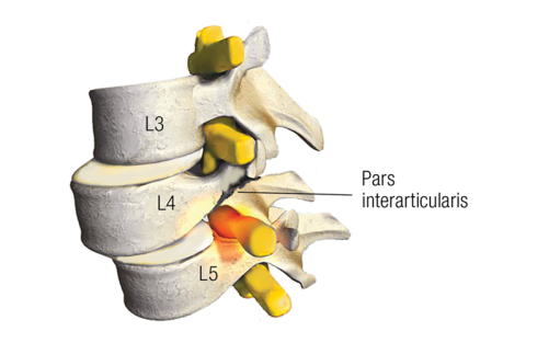 A sketch of discs L3-L5, showing a slippage causing sciatic nerve entrapment.