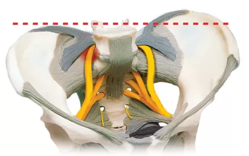 Partially anterior lateral view of the iliolumbar ligaments as they tighten down on the underlying nerve roots.