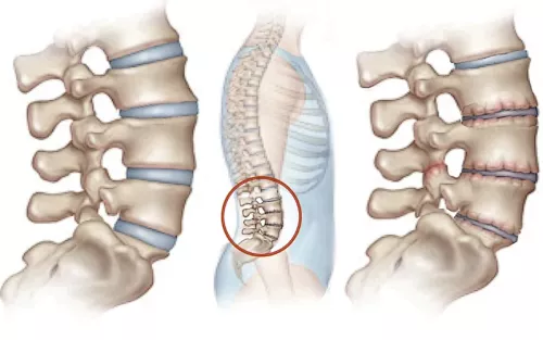 Lateral view of the spinal column zoomed in, showing healthly discs on the left and disc degeneration beginning on the right.