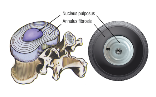 The annulus of the disc resembles a radial tire encapsulating the (hubcap) nucleus.