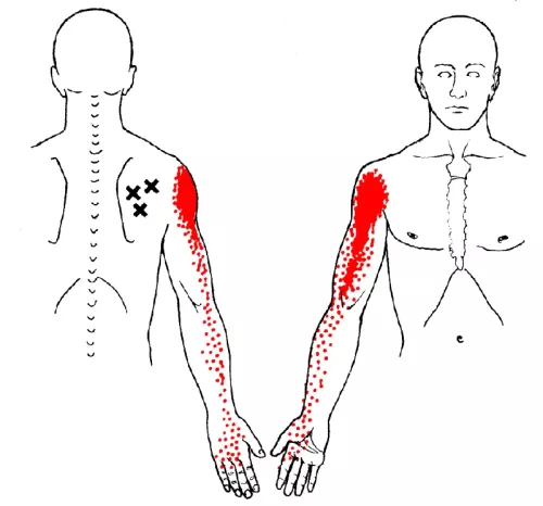 posterior (left) and anterior (right) view of a human body dotted with trigger points along the infraspinatus.