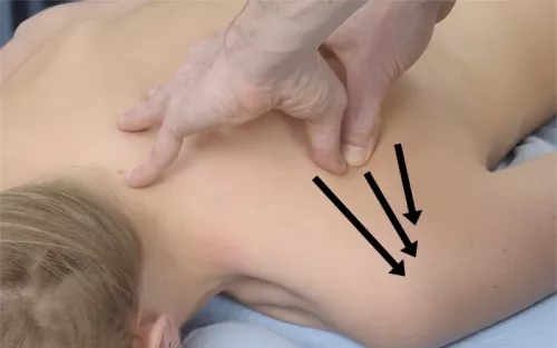 A therapist demonstrating deep stripping to the infraspinatus, arrows showing the direction diagonally laterally and down..