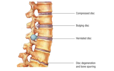 Lateral view of three different vertebral conditions: a compressed disc, bulging disc, and herniated disc.