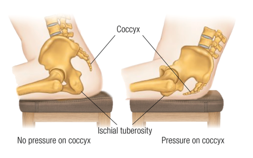 Coccydynia clients flex at the hips to shift weight to sits bones, the left has no pressure on the coccyx, and the right has pressure.