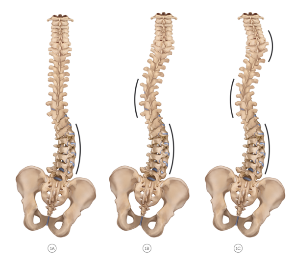 Three different spines, with a right C-curve, left S-scoliosis, and double S-scoliosis.