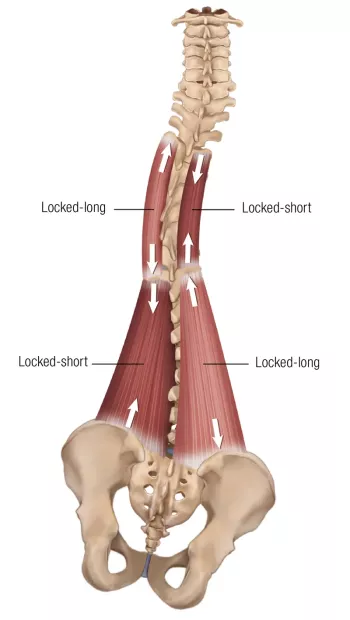 A scoliotic curve that's locked-long on the left side and locked-short on the right side.