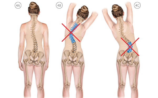 Posterior view of a human figure with left thoracic S-scoliosis, stretching the spine into right vs. left lateral flexion.