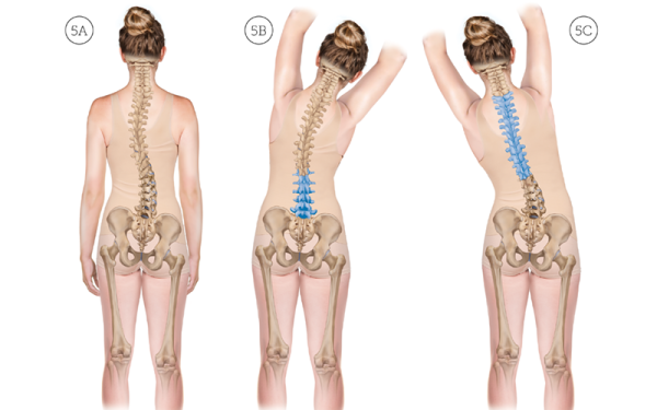 Right and left lateral flexion stretching of a scoliotic spine with the stretch force specifically focused to the intended region.