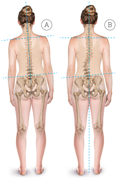 Left, a spine showing the effects of a dropped pelvis on one side. Right, the spine with a compensatory scoliotic curve to bring the head to a level posture.