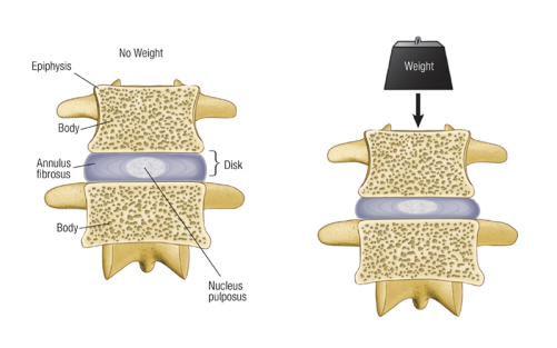 The annulus fibrosus fibrocartilage between two vertebrae, one with no weight added, one affected by weight.