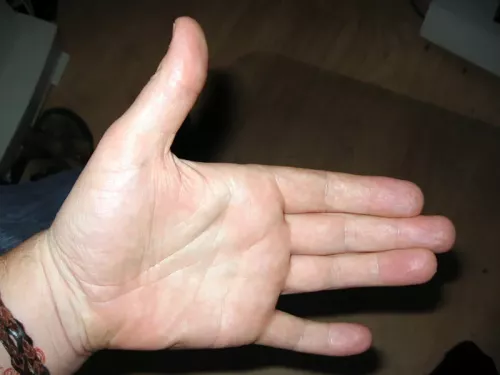 A person holding up a flat palm of their hand showing some mild atrophy.