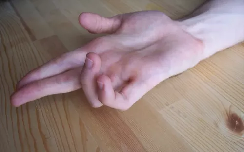 Two fingers curled or clawed can present with Guyon's canal syndrome.