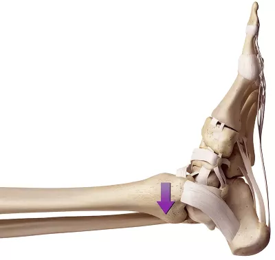  The tibia as it glides posteriorly on the talus. 