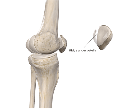 3D bones at patellar joint with ridge under the patella labeled.