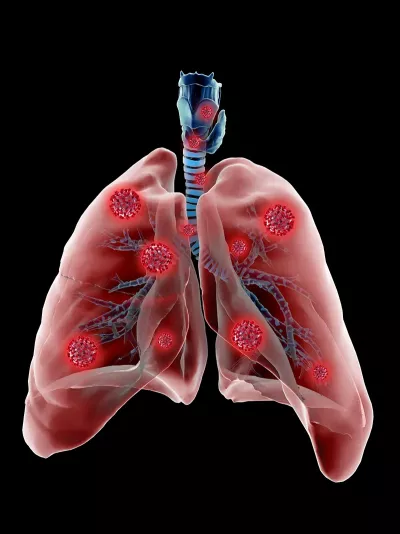 Illustration with two lungs and covid-19 pathogens inside.