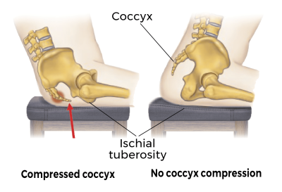 two images comparing how a seated client with coccyx pain may lean forward to relieve coccyx compression.