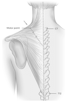 drawing of lines on shoulder near neck showing where motor point is located.