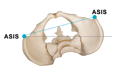 a anteriorly/inferiorly tilted ilium with the pelvic bowl rotated on a vertical axis.