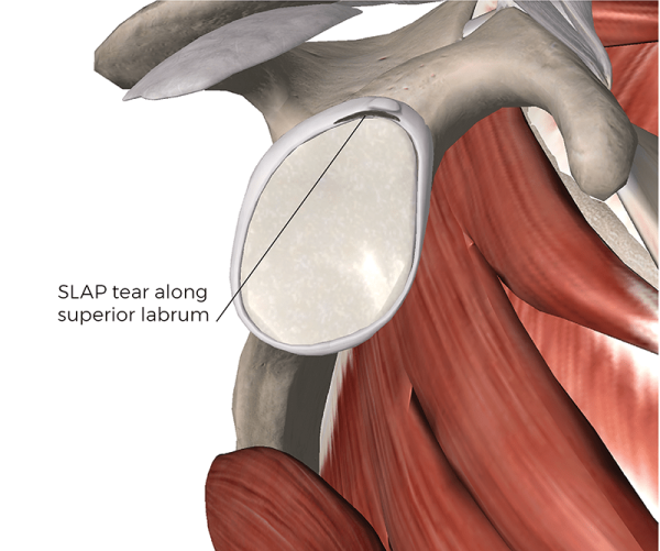 A SLAP (which stands for superior labrum anterior posterior) lesion of the labrum. 