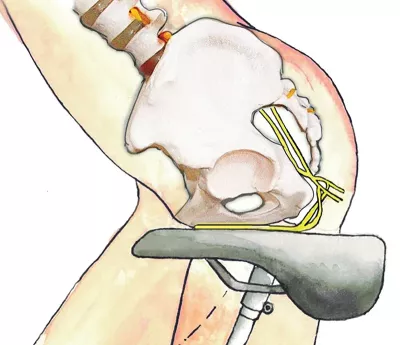Illustration of a buttocks sitting on a slim, hard bicycle saddle can compress the pudendal nerve.