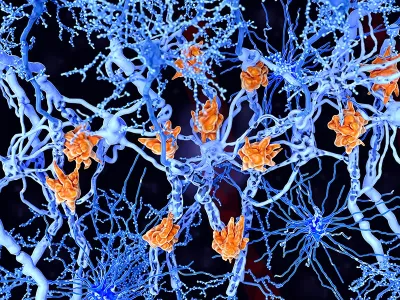 Orange pathogens attack a web of neurons within the central nervous system.