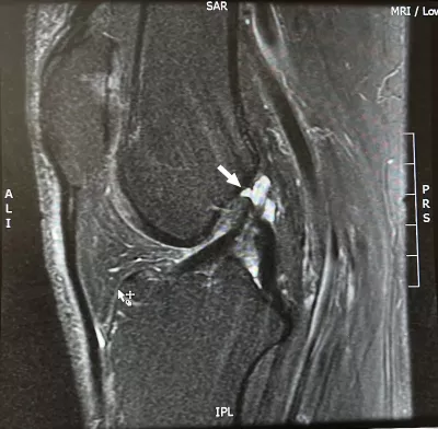 Sagittal MRI of the left knee showing ACL rupture.
