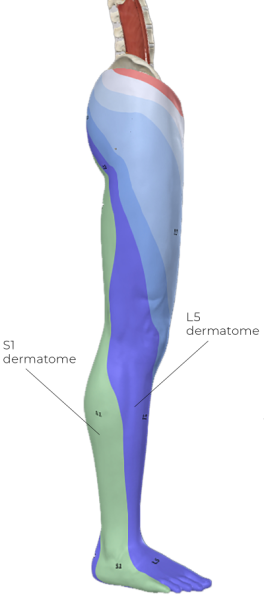 L5 dermatome and S1 dermatome are indicated.
