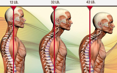Illustration showing three variations of forward-head posture.