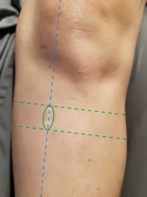 A leg with pattern highlighting Omni scar tissue pattern.