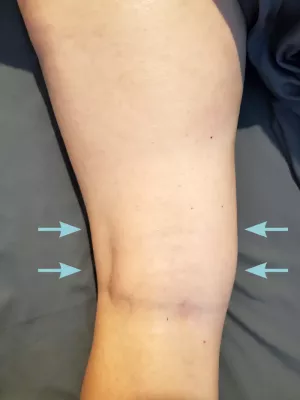 Image indicating scar restriction patterns.