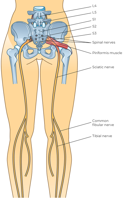 Illustration of the lower torso with the sciatic nerve and other nerves highlighted.