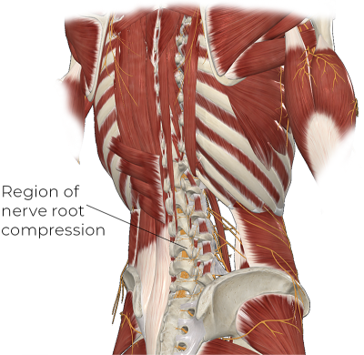 Skeletal and muscular illustration of the back side of a torso pointing out the region of nerve root compression.